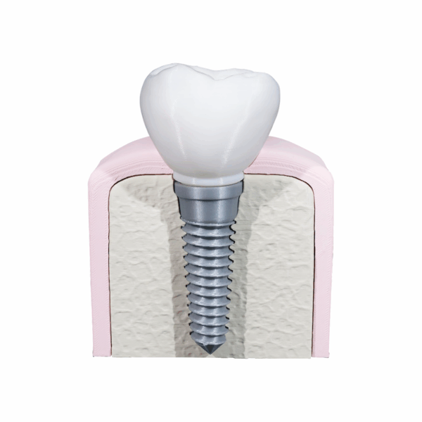 Machetă anatomică Implant Dentar