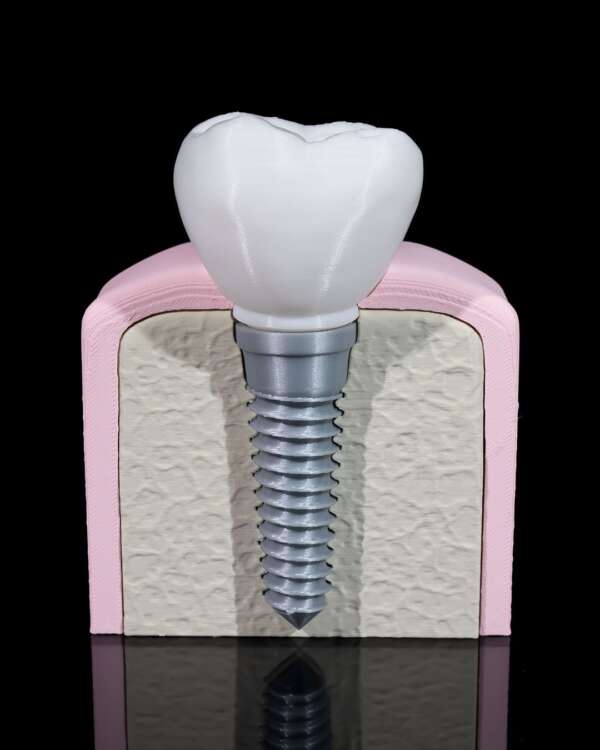 Machetă anatomică Implant Dentar - imagine 6