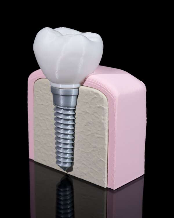 Machetă anatomică Implant Dentar - imagine 5